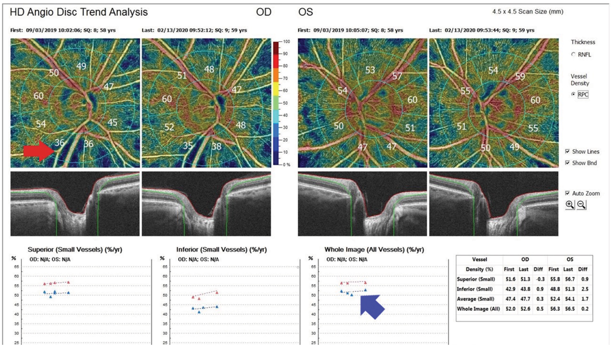 Hypoperfusion On Oct A Correlates With Vf Progression In Glaucoma